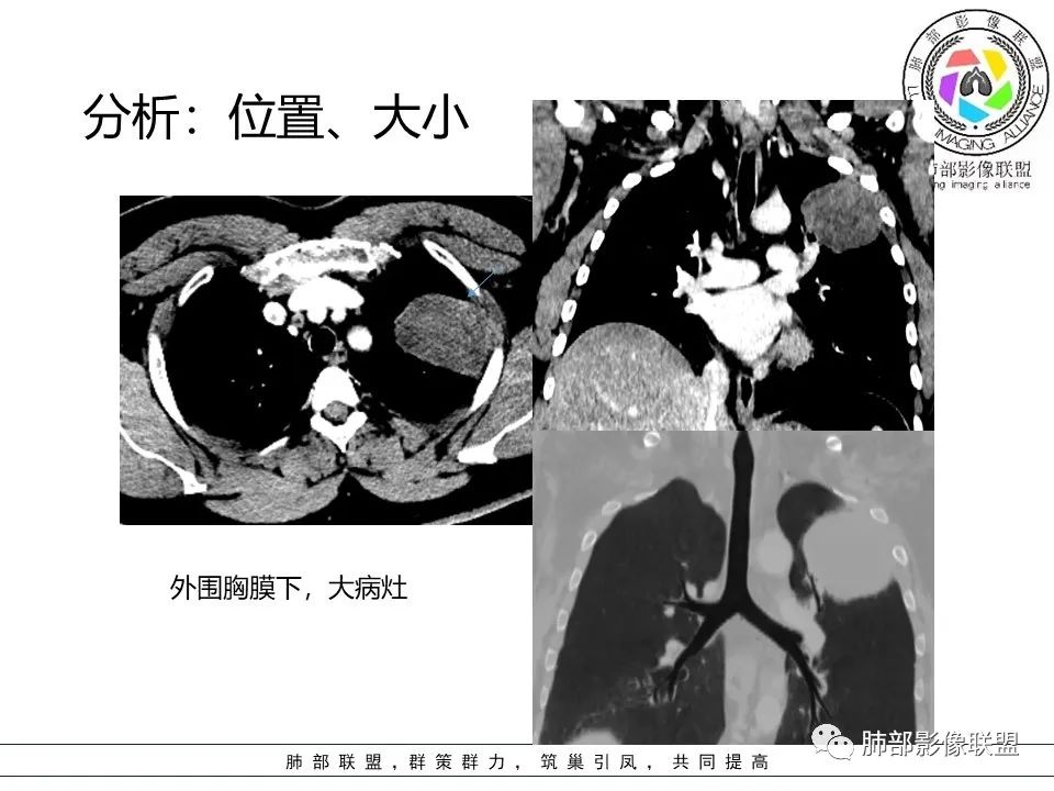 影像PPT - 【病例】左上胸骨外尤文氏肉瘤1例CT影像-49 影像PPT - 【病例】左上胸骨外尤文氏肉瘤1例CT影像-49