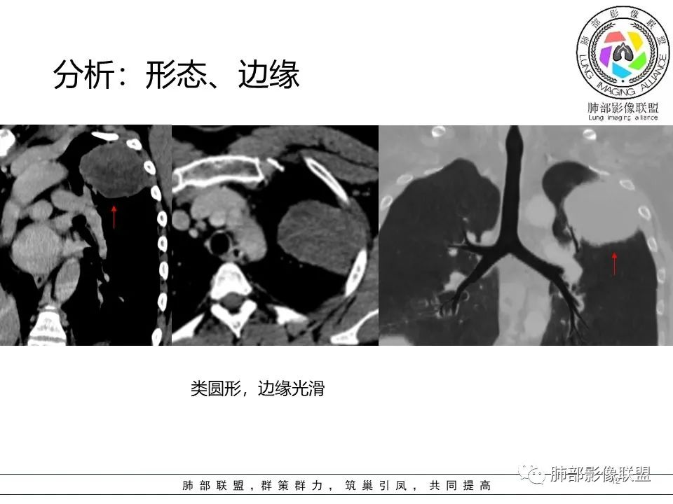 影像PPT - 【病例】左上胸骨外尤文氏肉瘤1例CT影像-50 影像PPT - 【病例】左上胸骨外尤文氏肉瘤1例CT影像-50