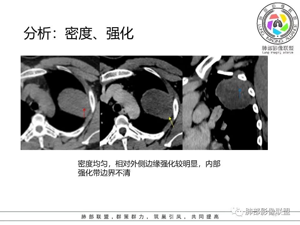 影像PPT - 【病例】左上胸骨外尤文氏肉瘤1例CT影像-51 影像PPT - 【病例】左上胸骨外尤文氏肉瘤1例CT影像-51