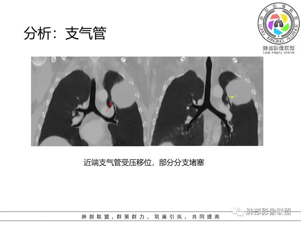影像PPT - 【病例】左上胸骨外尤文氏肉瘤1例CT影像-52 影像PPT - 【病例】左上胸骨外尤文氏肉瘤1例CT影像-52