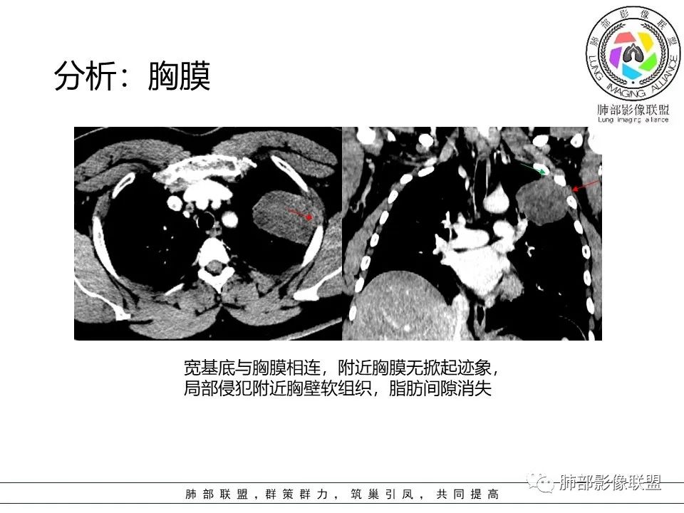 影像PPT - 【病例】左上胸骨外尤文氏肉瘤1例CT影像-53 影像PPT - 【病例】左上胸骨外尤文氏肉瘤1例CT影像-53