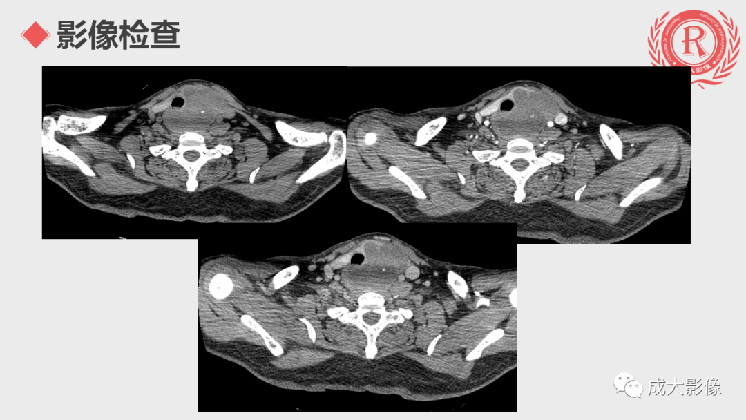 影像PPT - 【PPT】甲状腺癌影像学表现-2