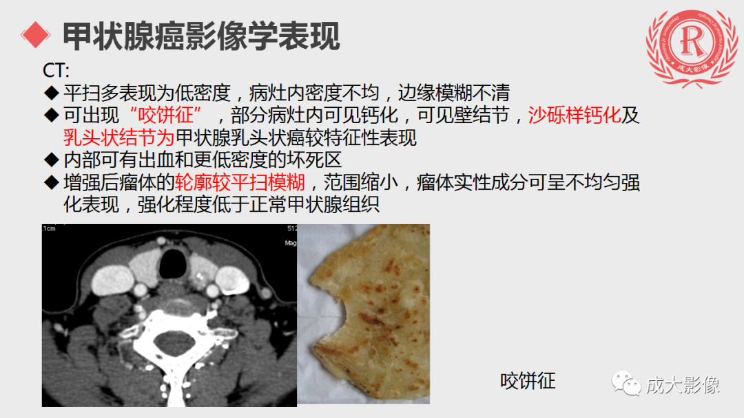 影像PPT - 【PPT】甲状腺癌影像学表现-9