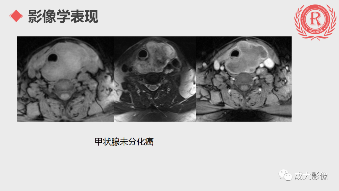 影像PPT - 【PPT】甲状腺癌影像学表现-11