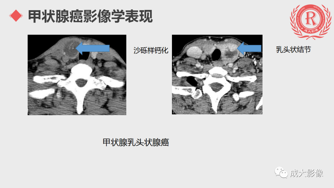 影像PPT - 【PPT】甲状腺癌影像学表现-12