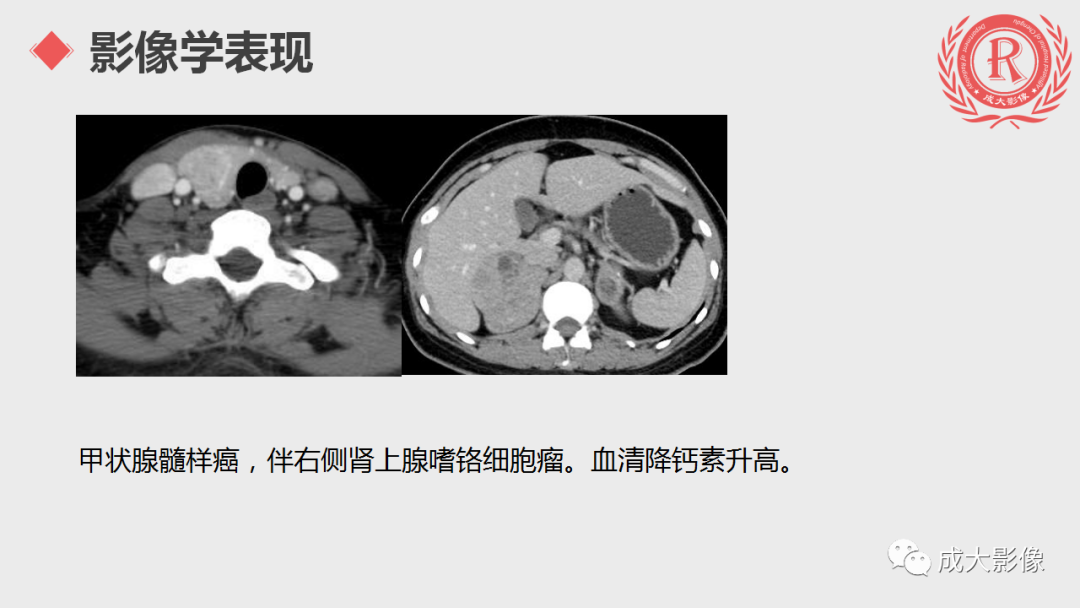 影像PPT - 【PPT】甲状腺癌影像学表现-14