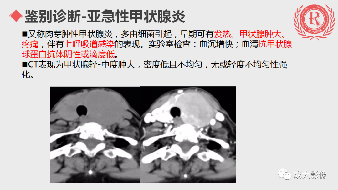 影像PPT - 【PPT】甲状腺癌影像学表现-15