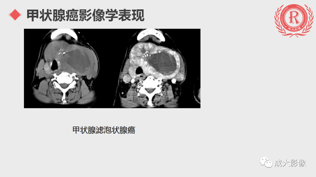 影像PPT - 【PPT】甲状腺癌影像学表现-13