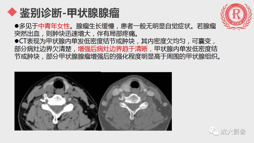 影像PPT - 【PPT】甲状腺癌影像学表现-17