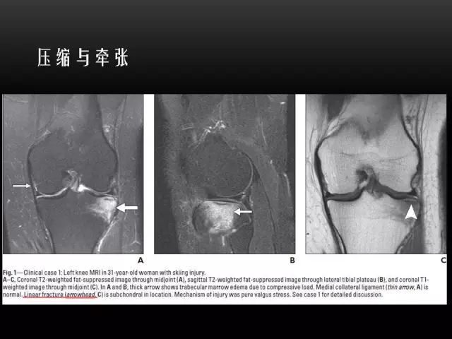 影像PPT - 【PPT】膝关节骨挫伤的分类及MRI表现特点-5
