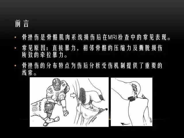 影像PPT - 【PPT】膝关节骨挫伤的分类及MRI表现特点-1