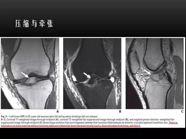 影像PPT - 【PPT】膝关节骨挫伤的分类及MRI表现特点-6