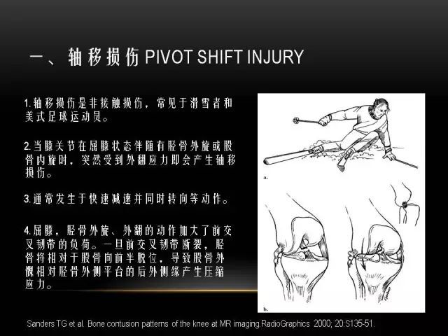 影像PPT - 【PPT】膝关节骨挫伤的分类及MRI表现特点-9