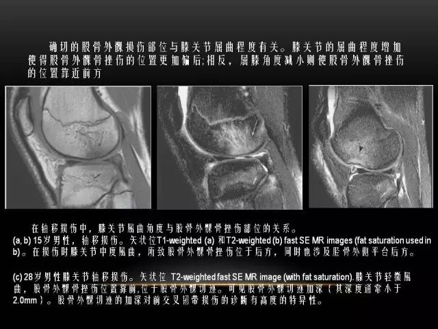 影像PPT - 【PPT】膝关节骨挫伤的分类及MRI表现特点-11