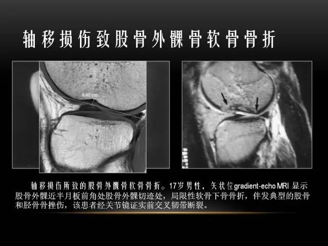 影像PPT - 【PPT】膝关节骨挫伤的分类及MRI表现特点-12