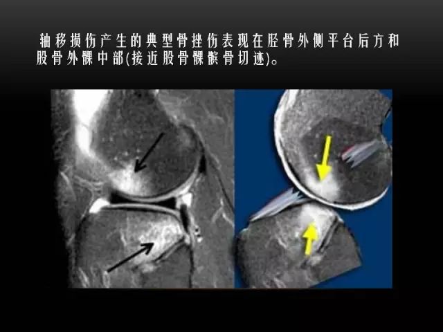 影像PPT - 【PPT】膝关节骨挫伤的分类及MRI表现特点-10