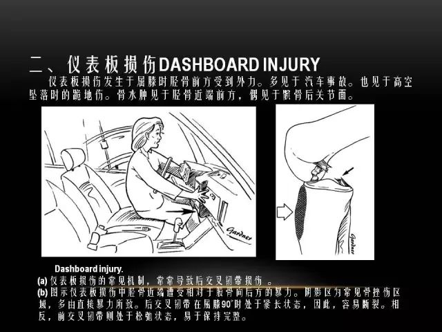 影像PPT - 【PPT】膝关节骨挫伤的分类及MRI表现特点-15