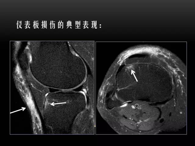 影像PPT - 【PPT】膝关节骨挫伤的分类及MRI表现特点-16