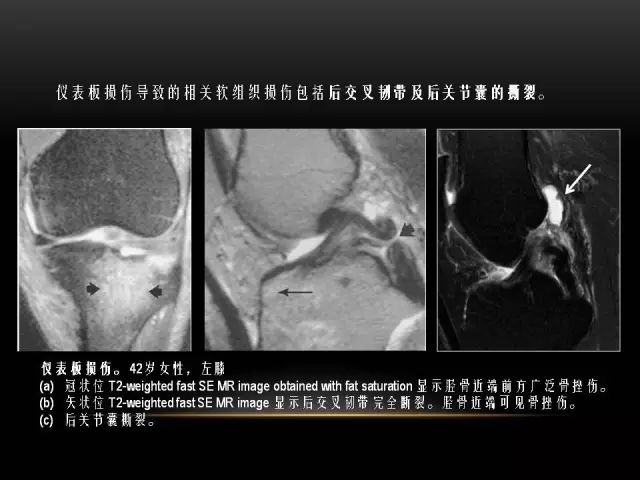 影像PPT - 【PPT】膝关节骨挫伤的分类及MRI表现特点-17