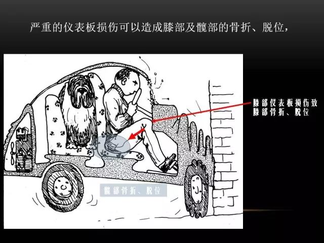 影像PPT - 【PPT】膝关节骨挫伤的分类及MRI表现特点-18