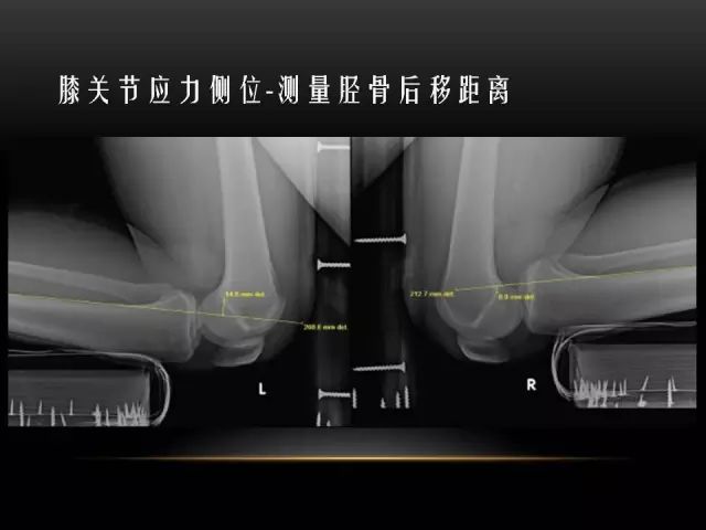 影像PPT - 【PPT】膝关节骨挫伤的分类及MRI表现特点-19