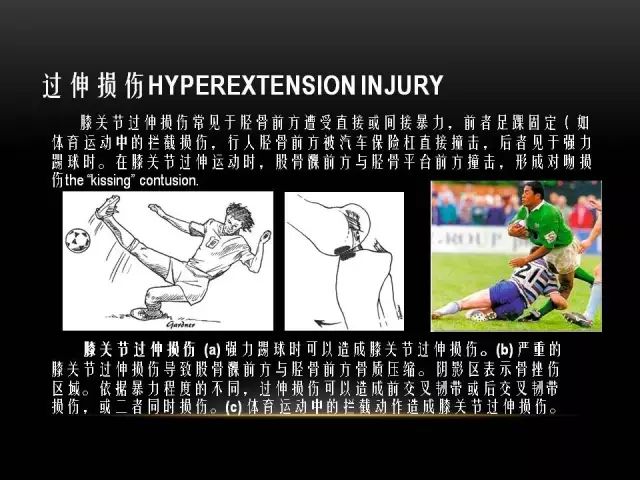 影像PPT - 【PPT】膝关节骨挫伤的分类及MRI表现特点-21