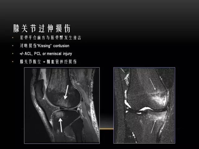 影像PPT - 【PPT】膝关节骨挫伤的分类及MRI表现特点-22