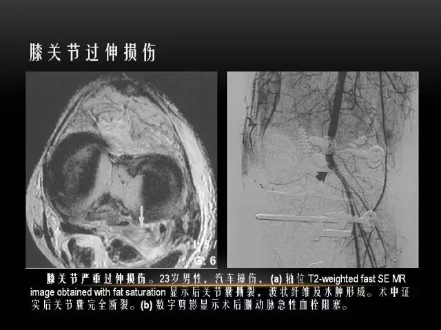 影像PPT - 【PPT】膝关节骨挫伤的分类及MRI表现特点-23