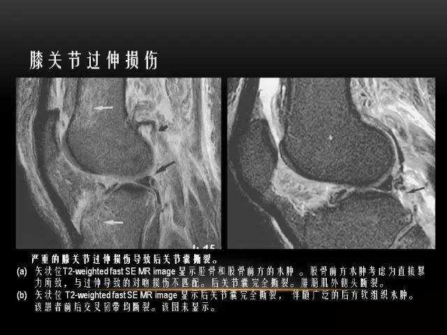影像PPT - 【PPT】膝关节骨挫伤的分类及MRI表现特点-24