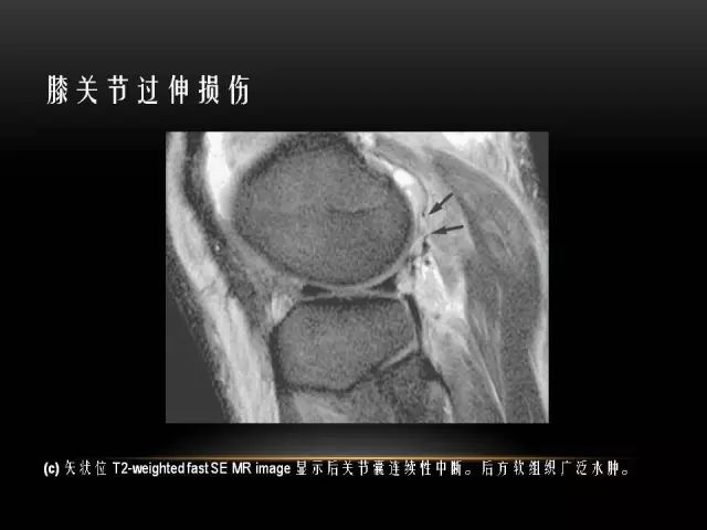 影像PPT - 【PPT】膝关节骨挫伤的分类及MRI表现特点-25