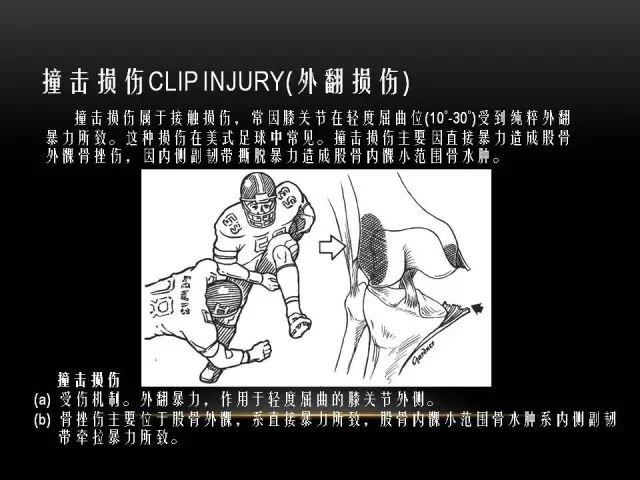 影像PPT - 【PPT】膝关节骨挫伤的分类及MRI表现特点-26