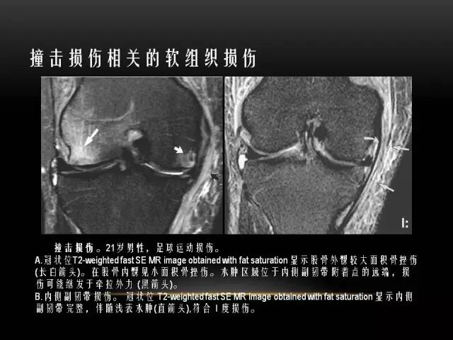 影像PPT - 【PPT】膝关节骨挫伤的分类及MRI表现特点-28