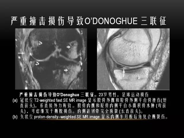 影像PPT - 【PPT】膝关节骨挫伤的分类及MRI表现特点-29