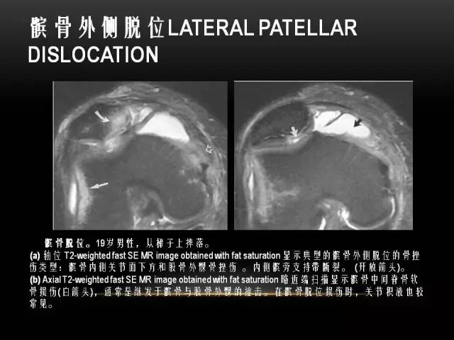 影像PPT - 【PPT】膝关节骨挫伤的分类及MRI表现特点-33