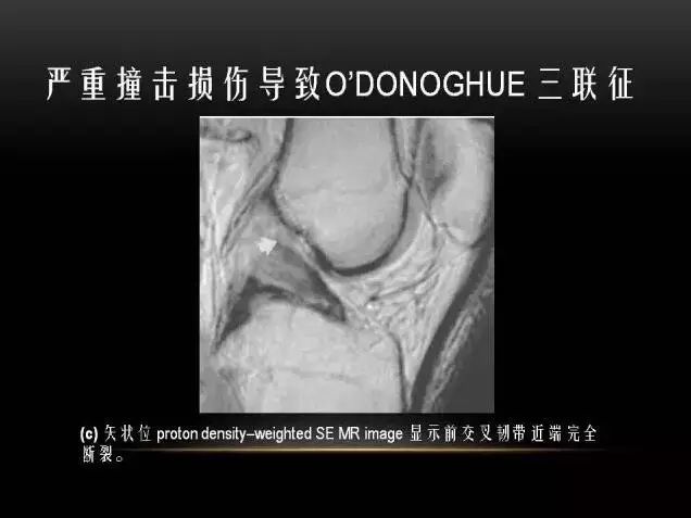 影像PPT - 【PPT】膝关节骨挫伤的分类及MRI表现特点-30