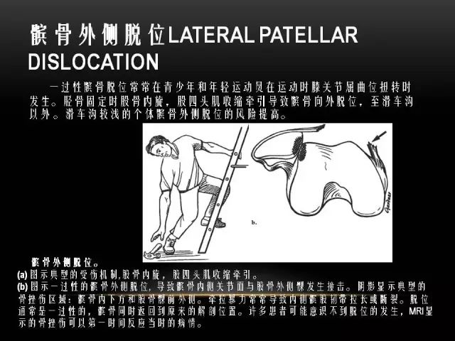 影像PPT - 【PPT】膝关节骨挫伤的分类及MRI表现特点-31