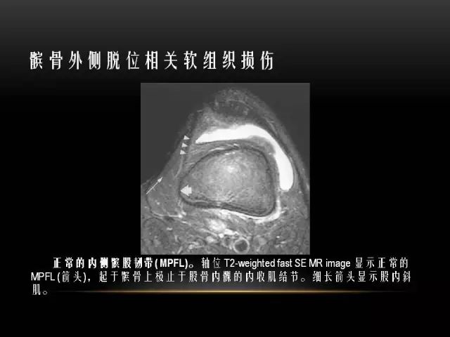 影像PPT - 【PPT】膝关节骨挫伤的分类及MRI表现特点-37