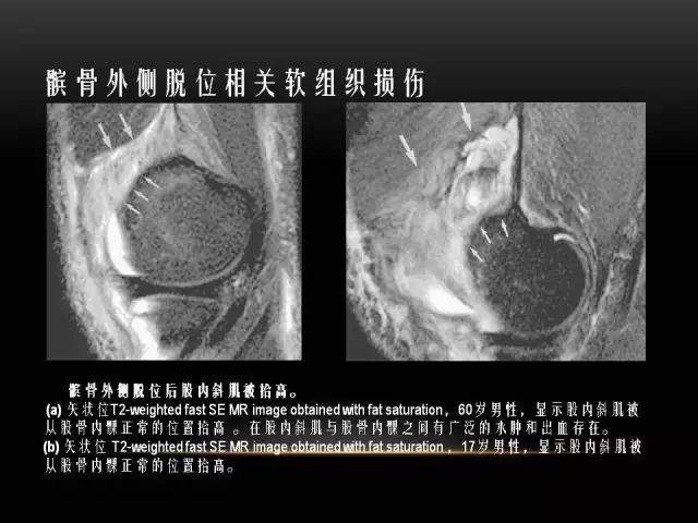 影像PPT - 【PPT】膝关节骨挫伤的分类及MRI表现特点-40