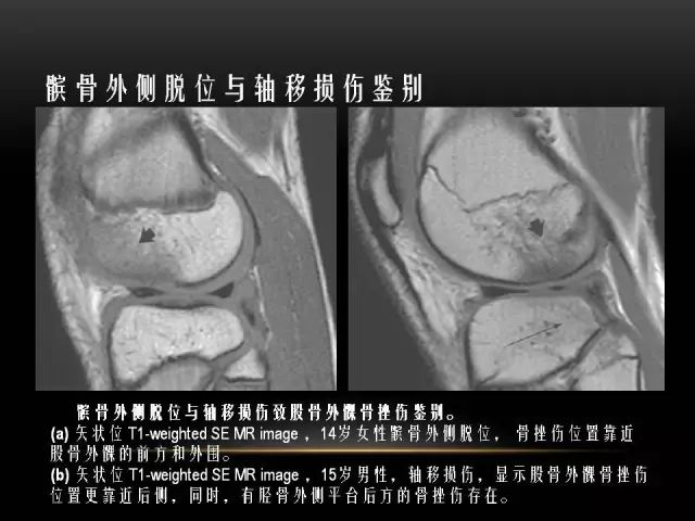 影像PPT - 【PPT】膝关节骨挫伤的分类及MRI表现特点-35
