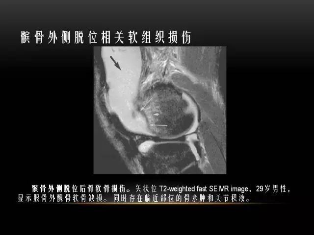 影像PPT - 【PPT】膝关节骨挫伤的分类及MRI表现特点-41