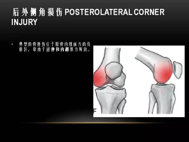 影像PPT - 【PPT】膝关节骨挫伤的分类及MRI表现特点-42