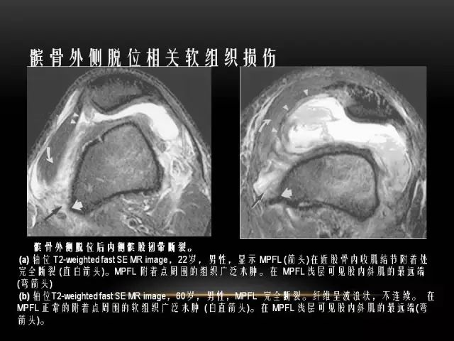 影像PPT - 【PPT】膝关节骨挫伤的分类及MRI表现特点-39