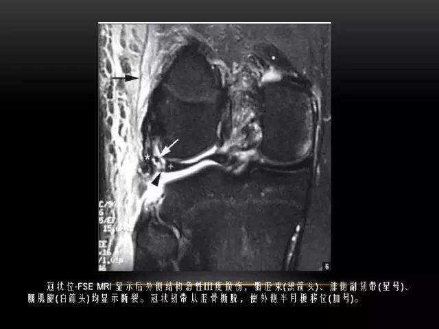 影像PPT - 【PPT】膝关节骨挫伤的分类及MRI表现特点-47