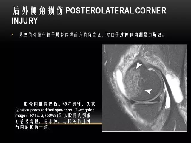 影像PPT - 【PPT】膝关节骨挫伤的分类及MRI表现特点-46