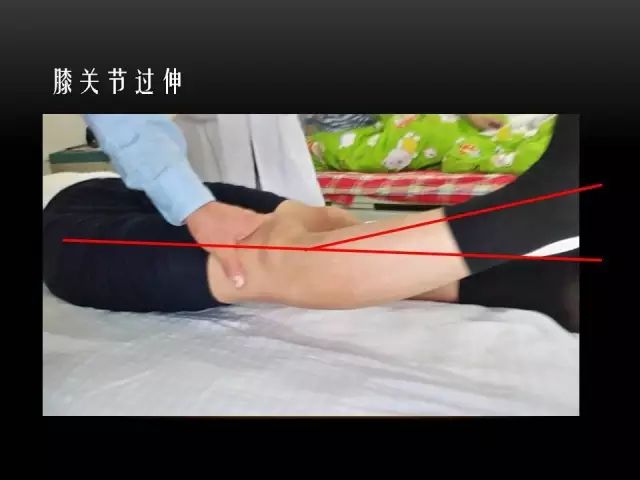 影像PPT - 【PPT】膝关节骨挫伤的分类及MRI表现特点-49