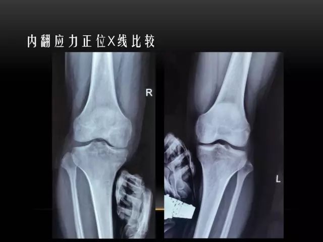 影像PPT - 【PPT】膝关节骨挫伤的分类及MRI表现特点-51