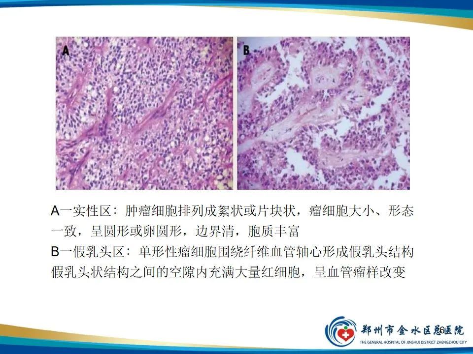 影像PPT - 【PPT】胰腺实性假乳头状瘤影像学表现-6
