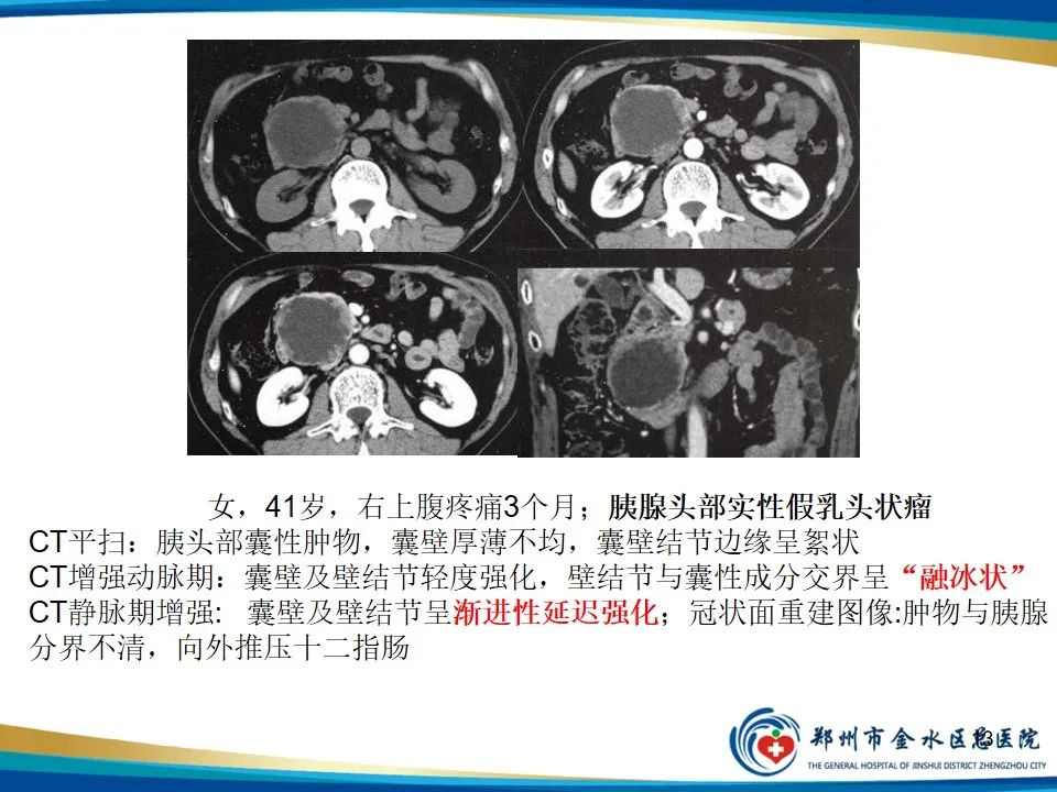 影像PPT - 【PPT】胰腺实性假乳头状瘤影像学表现-13