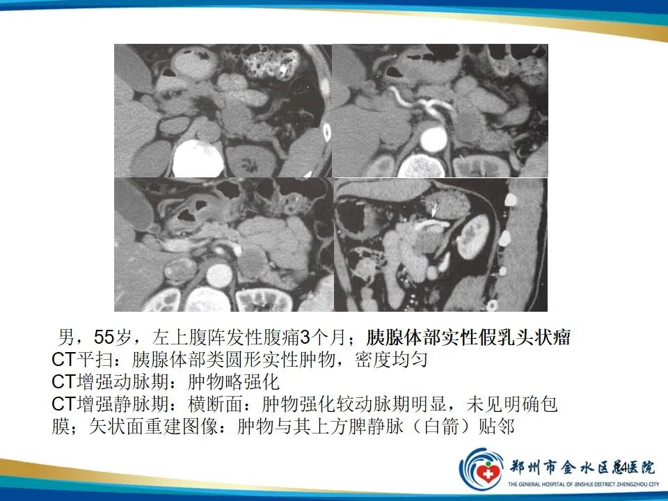 影像PPT - 【PPT】胰腺实性假乳头状瘤影像学表现-14