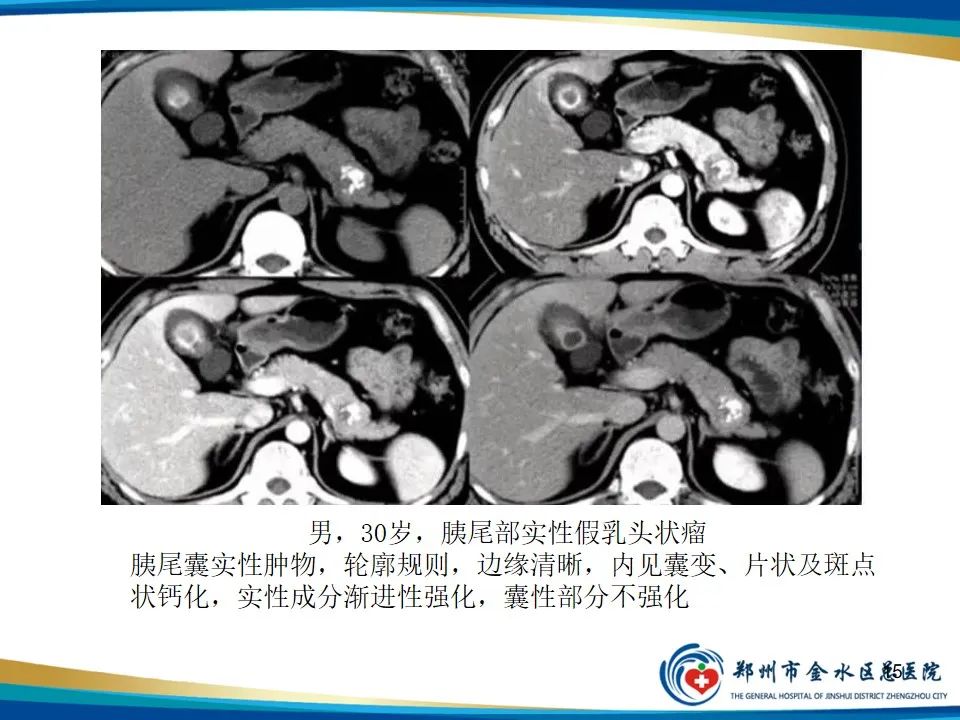 影像PPT - 【PPT】胰腺实性假乳头状瘤影像学表现-15